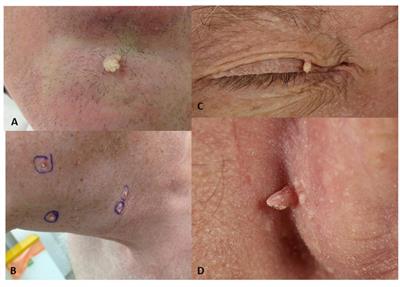 The Role of Human Papillomaviruses and Polyomaviruses in BRAF-Inhibitor Induced Cutaneous Squamous Cell Carcinoma and Benign Squamoproliferative Lesions